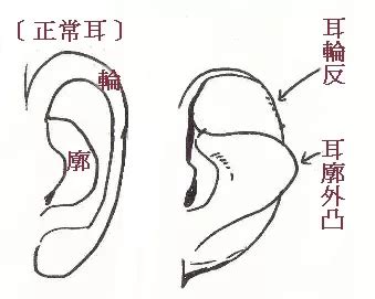 反廓耳|面相入门